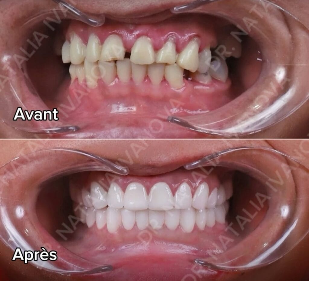 gingival