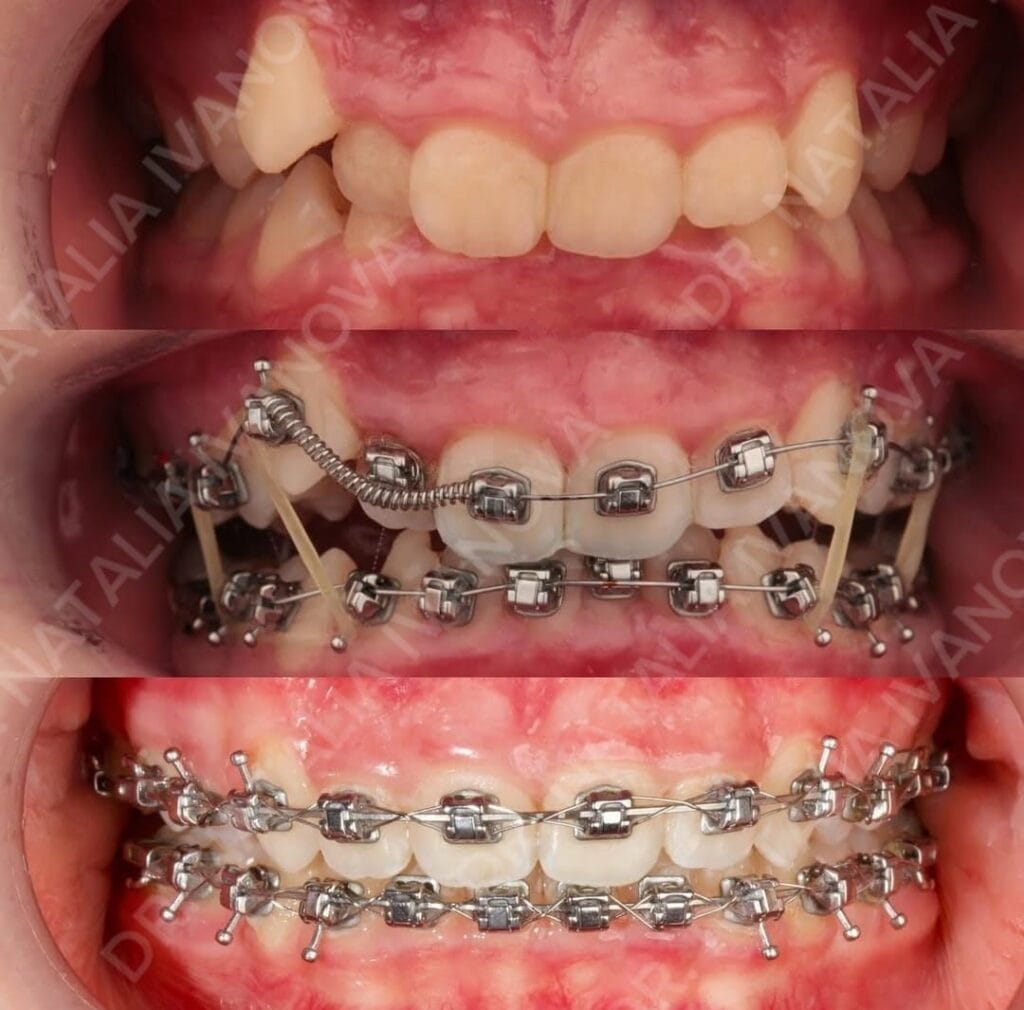 BBRACES