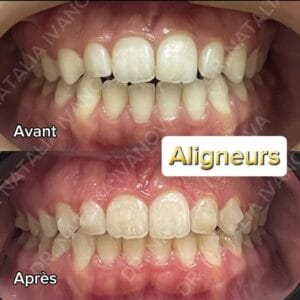 aligneurs
