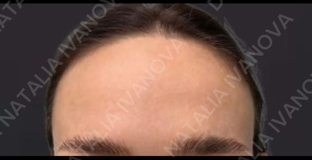 botox1