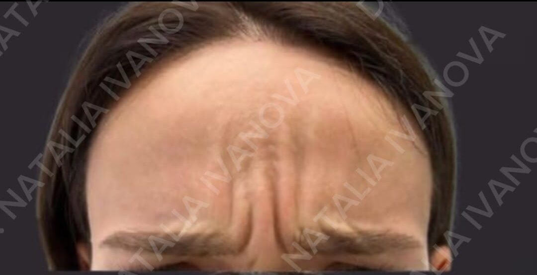 botox2