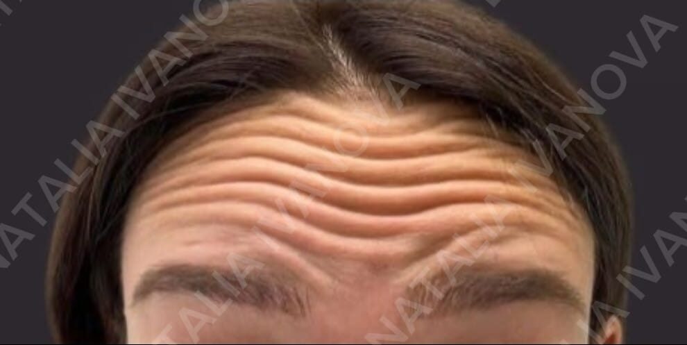 botox3