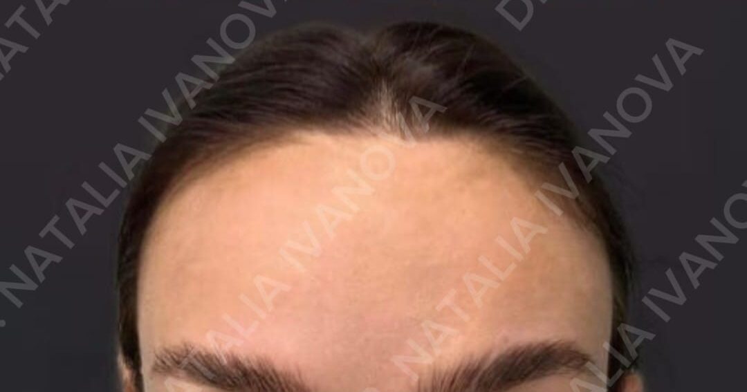 botox4