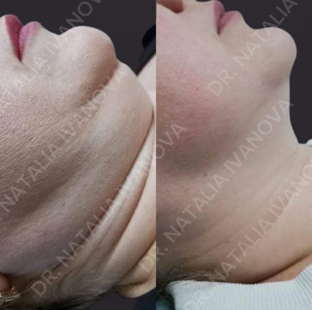 botox5