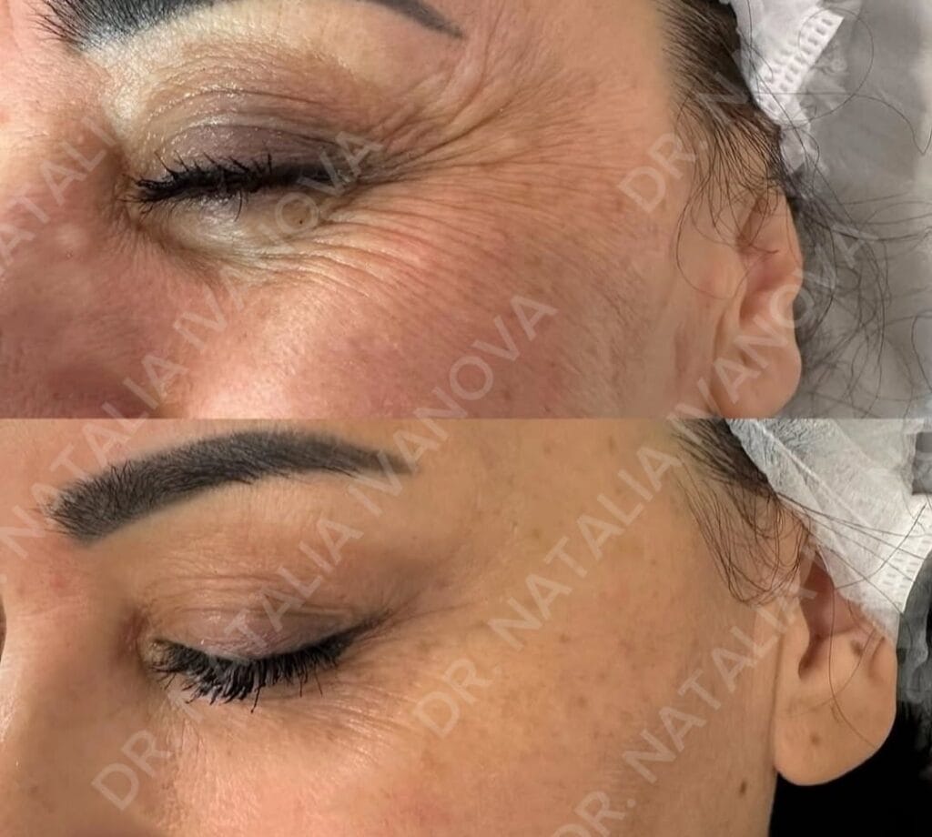 botox6
