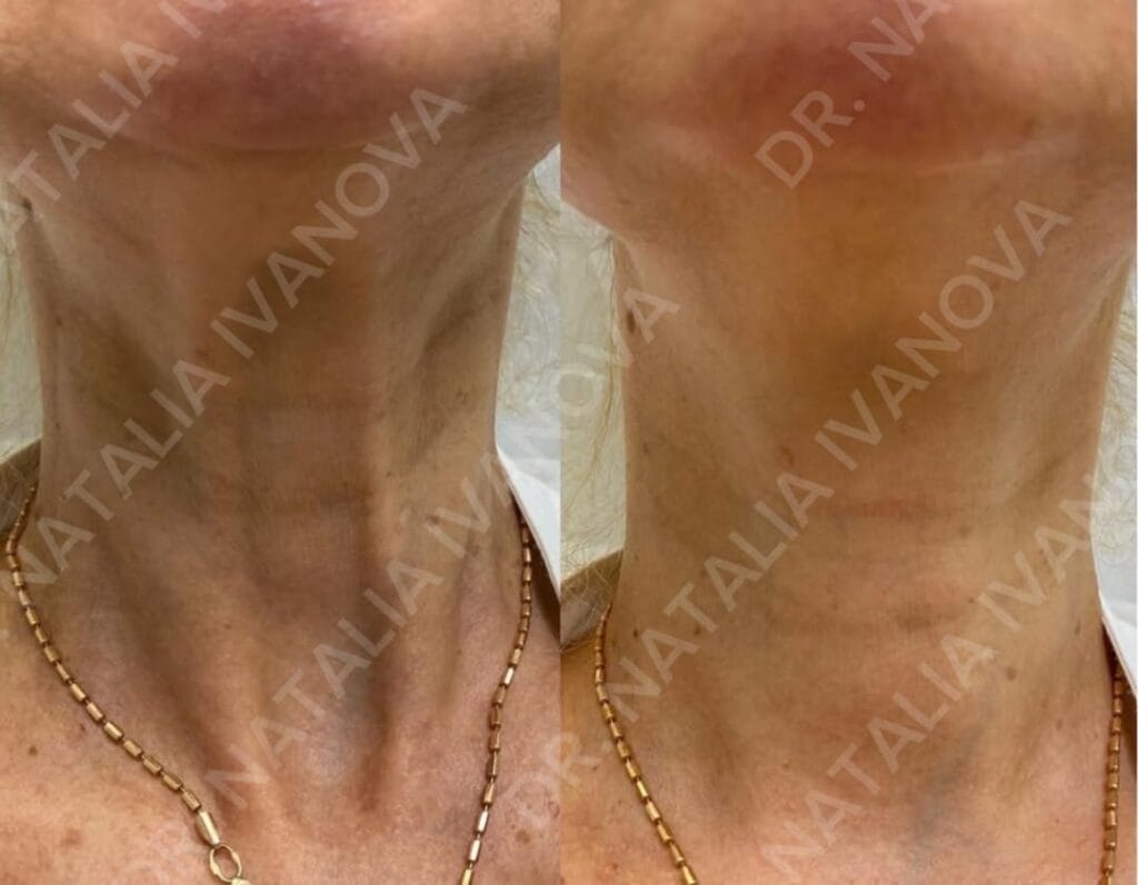botox7