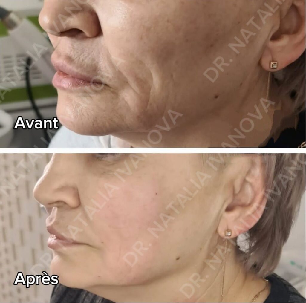 collagen3
