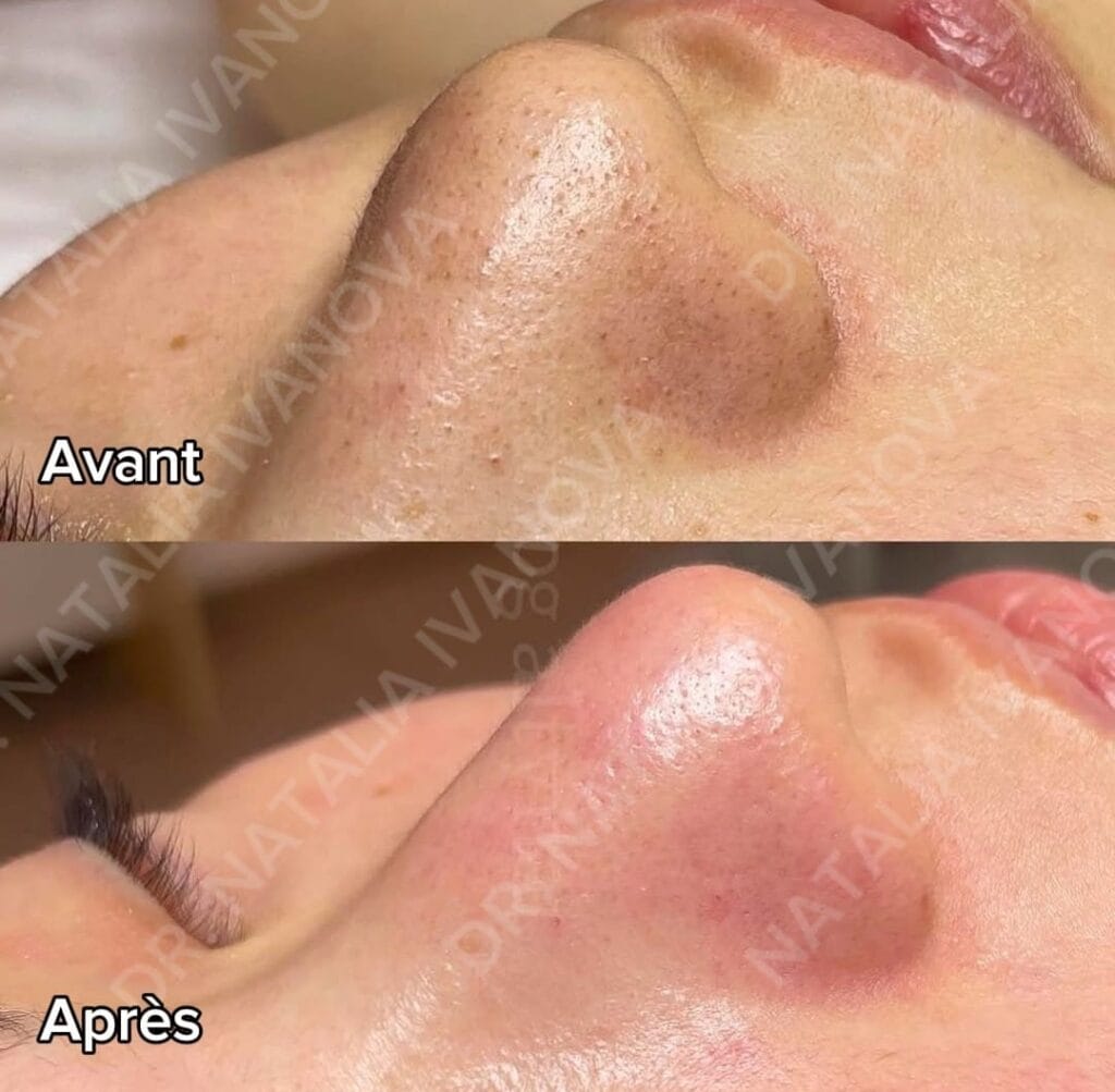 hydrafacial1