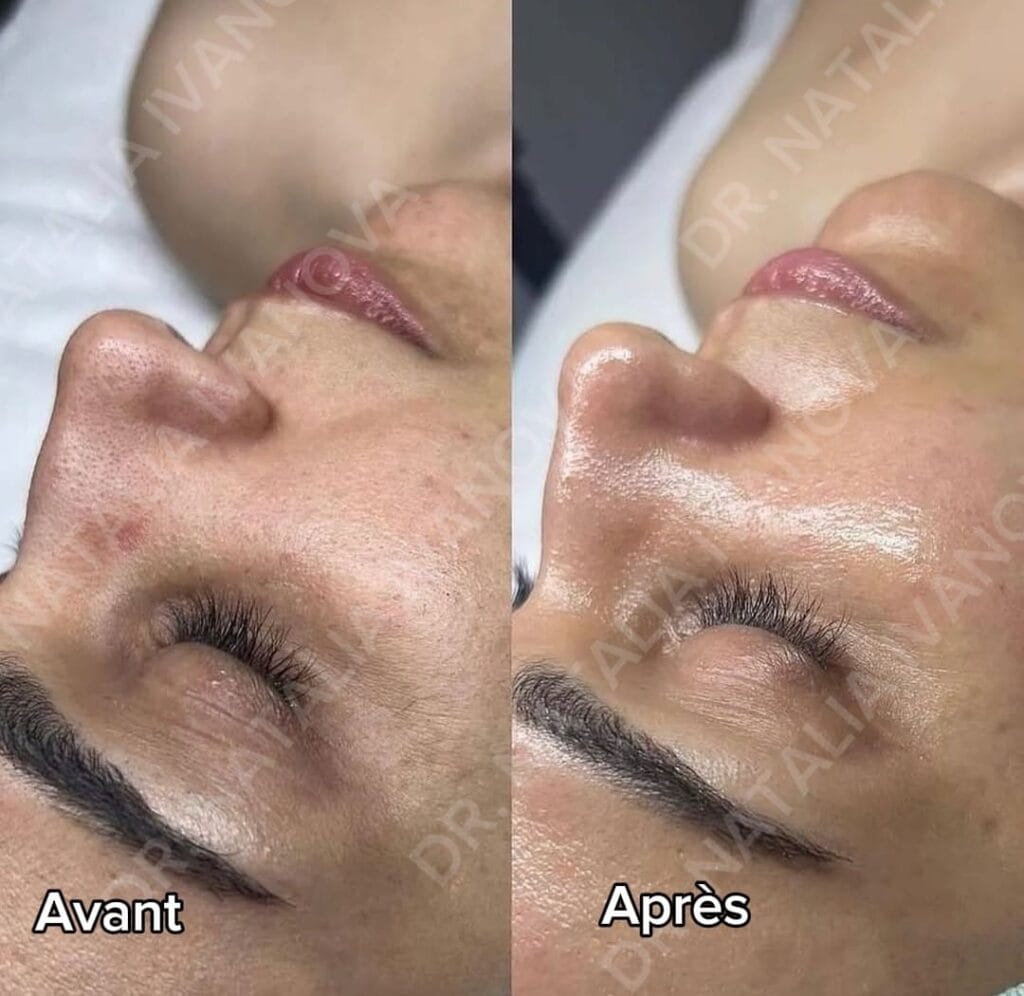 hydrafacial2
