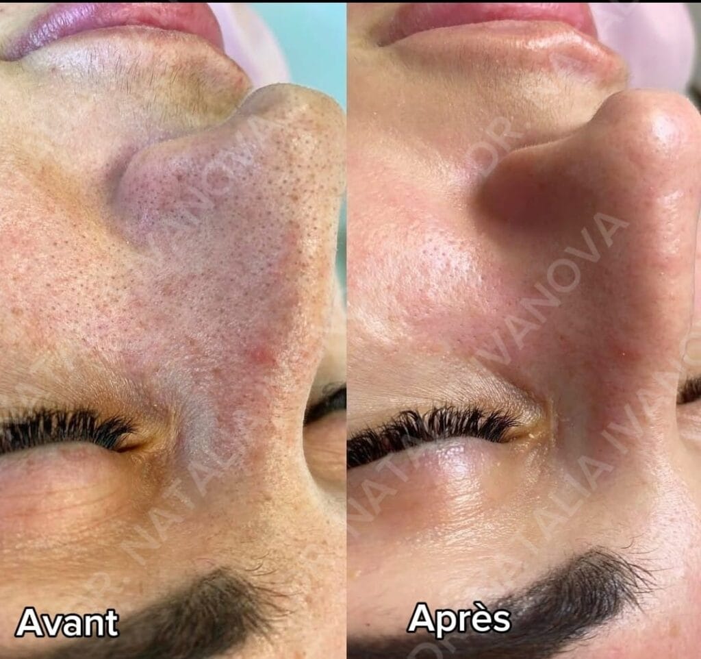 hydrafacial4