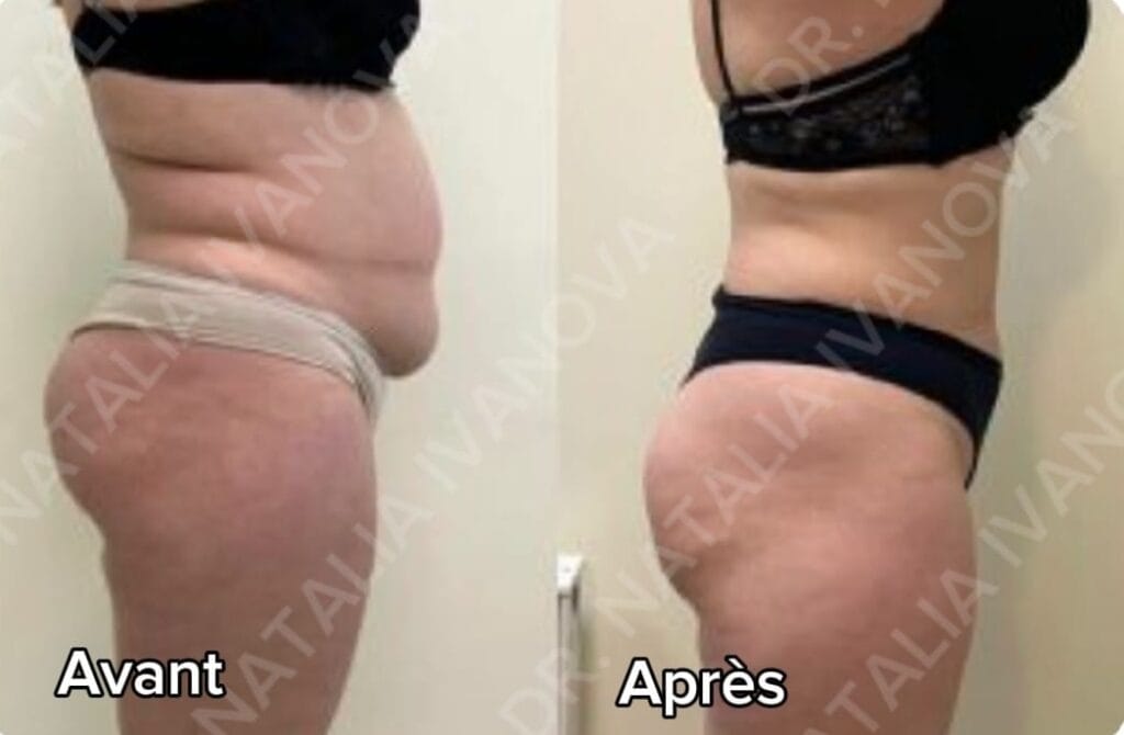 lypo1 e1749473916228