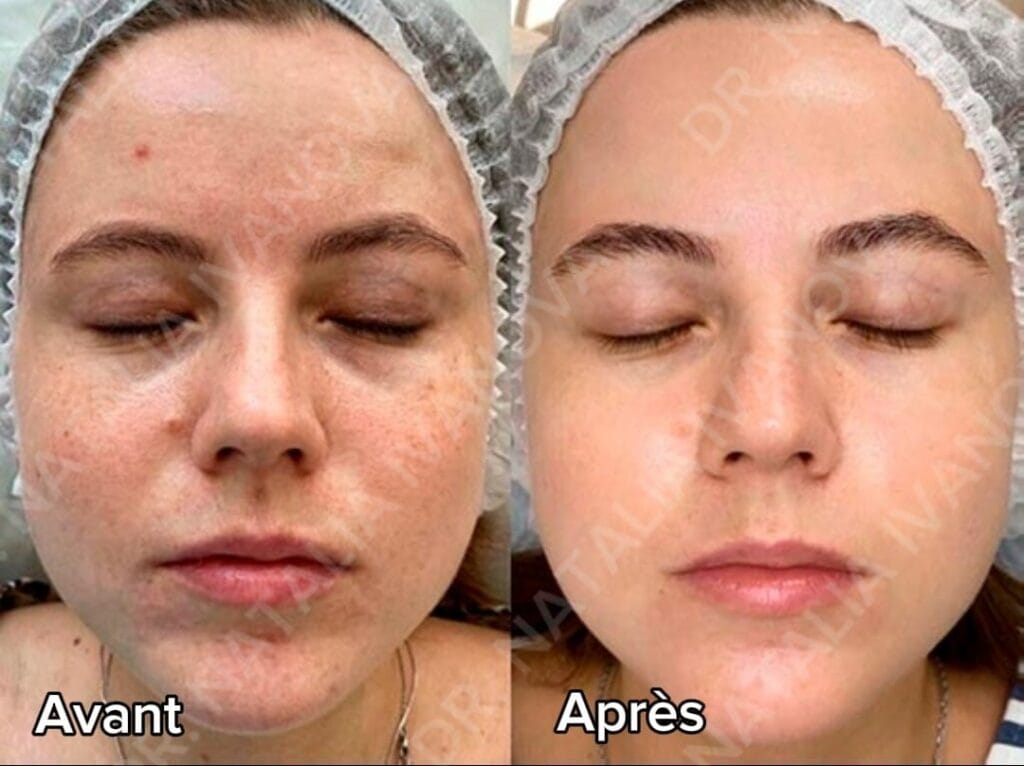 peeling2